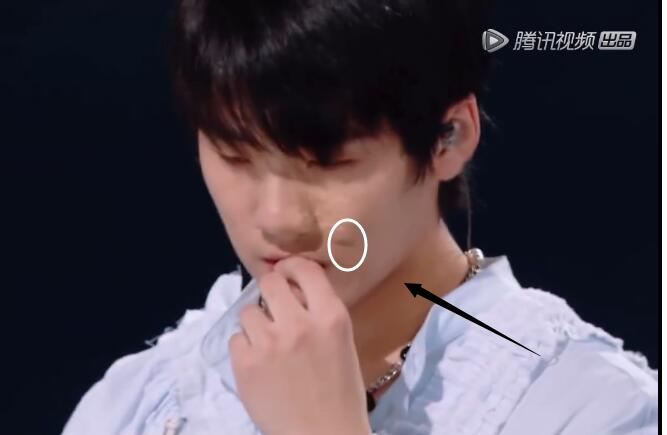 沈钲博脸上是什么胎记?他为什么不去做手术去掉胎记?