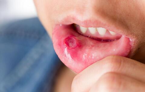 口腔溃疡是什么原因造成，多种因素综合作用的结果！