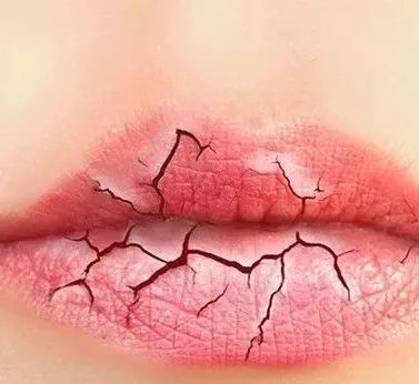 嘴角开裂是什么原因，有可能是缺乏维生素造成！