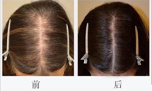 植发有用吗？头发种植后几天能上班?