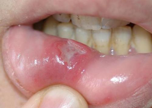 口腔溃疡是什么原因造成，多种因素综合作用的结果！