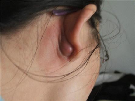 耳垂里面长了个硬疙瘩是什么原因，应该怎么办？